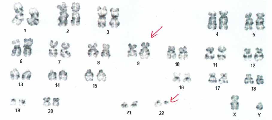 I) Karyogram showing 46,XY,t(9;22)(q34;q11.2)